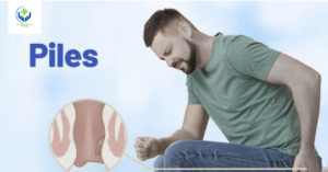 Top 7 Secrets to Control Piles (Hemorrhoids) Naturally with Homeopathy