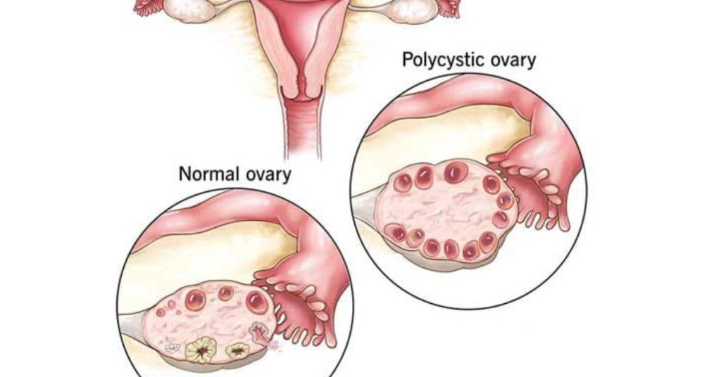 PCOD Treatment in Homeopathy