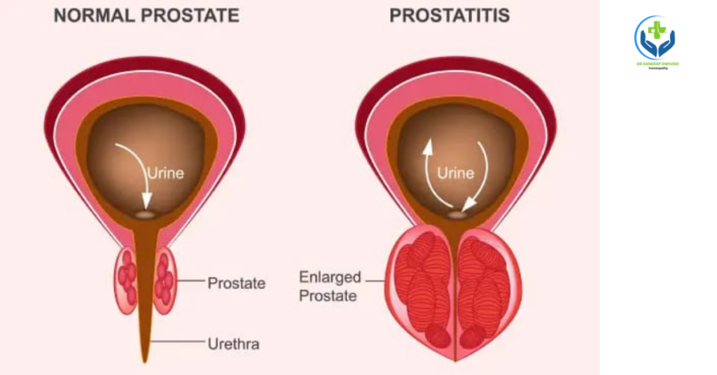 Prostate Disease Treatment